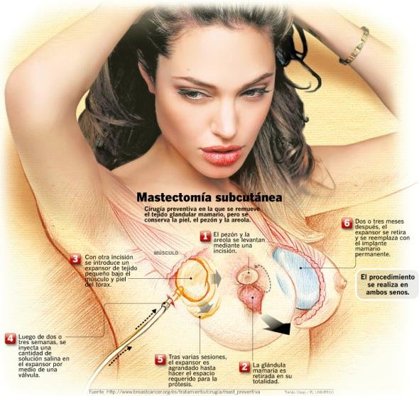mastectomiaangelina