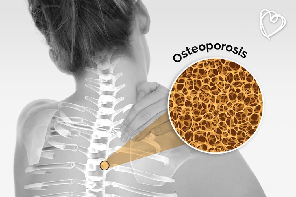 Hábitos para prevenir la osteoporosis