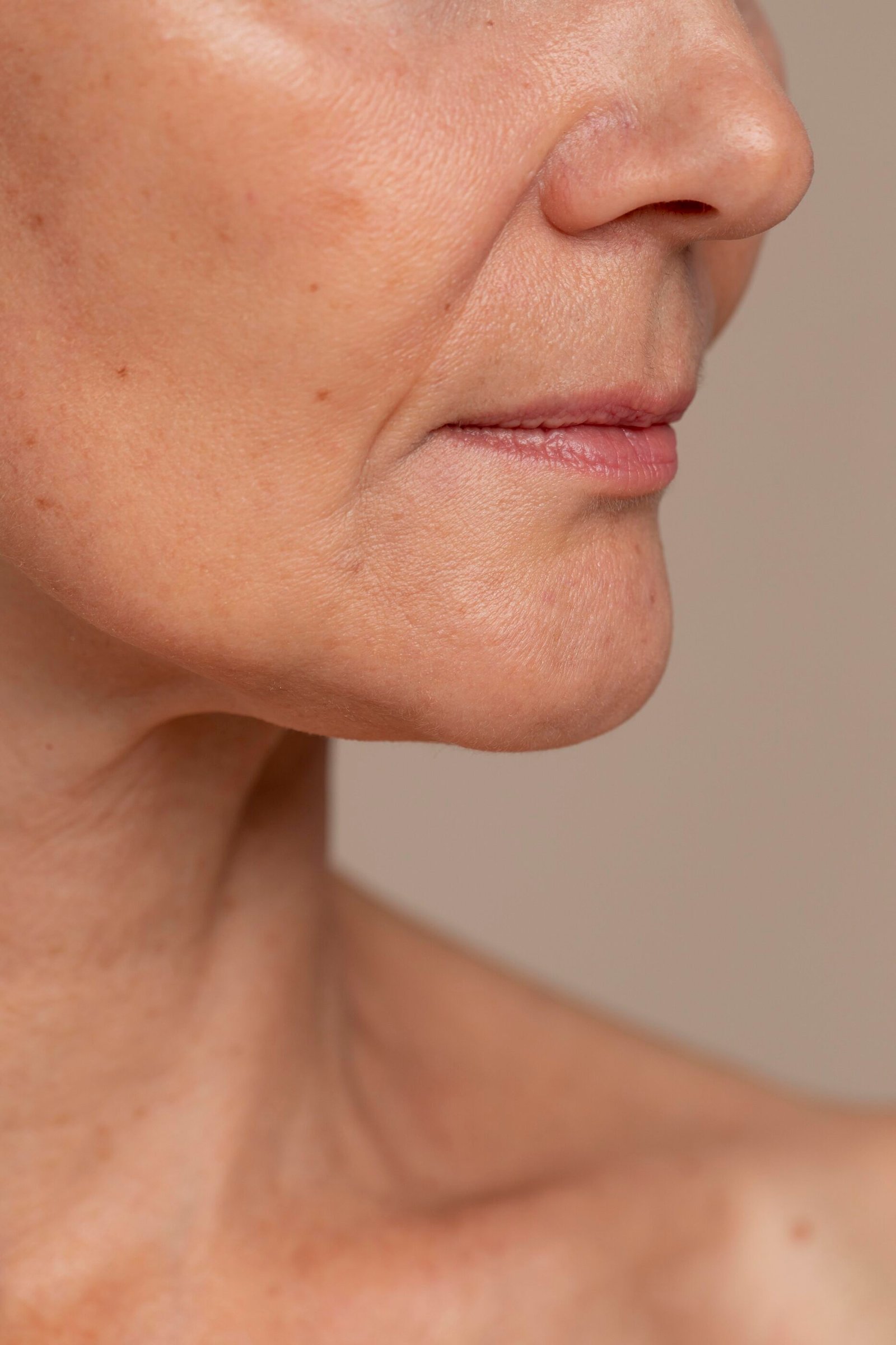 El melasma: control, tratamiento y prevención