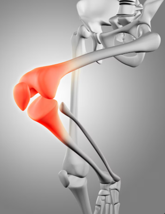 Osteoartritis en México