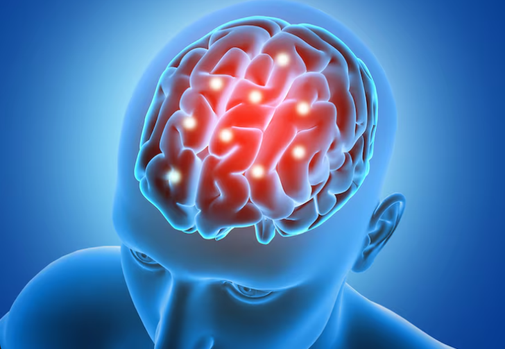 Derrame cerebral